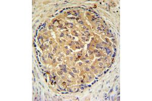 SRD5A3 Antibody IHC analysis in formalin fixed and paraffin embedded human prostate carcinoma followed by peroxidase conjugation of the secondary antibody and DAB staining. (SRD5A3 Antikörper  (C-Term))