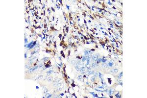 Immunohistochemistry of paraffin-embedded human colon carcinoma using FSP1/S100 Rabbit mAb (ABIN7270125) at dilution of 1:100 (40x lens). (s100a4 Antikörper)