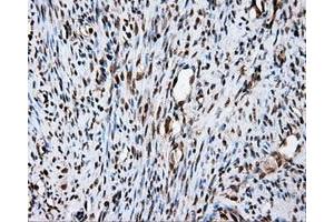 Immunohistochemical staining of paraffin-embedded Carcinoma of liver tissue using anti-FAHD2A mouse monoclonal antibody. (FAHD2A Antikörper)