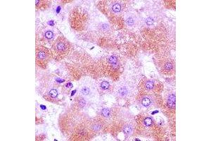 Immunohistochemical analysis of FURIN staining in human liver cancer formalin fixed paraffin embedded tissue section. (FURIN Antikörper)