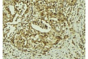 ABIN6273150 at 1/100 staining Human breast cancer tissue by IHC-P. (PRPF8 Antikörper  (C-Term))