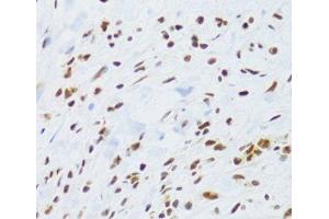 Immunohistochemistry of paraffin-embedded Human gastric cancer using DDB1 Polyclonal Antibody at dilution of 1:100 (40x lens). (DDB1 Antikörper)