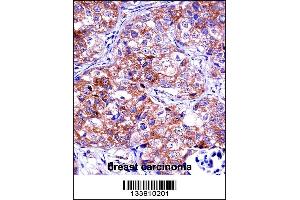 IMPDH1 Antibody immunohistochemistry analysis in formalin fixed and paraffin embedded human breast carcinoma followed by peroxidase conjugation of the secondary antibody and DAB staining. (IMPDH1 Antikörper  (C-Term))