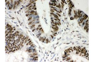 Anti- Nucleophosmin Picoband antibody,IHC(P) IHC(P): Human Intestinal Cancer Tissue (NPM1 Antikörper  (AA 1-294))