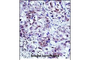 HIST1H1D Antibody (Center) (ABIN657667 and ABIN2846660) immunohistochemistry analysis in formalin fixed and paraffin embedded human breast carcinoma followed by peroxidase conjugation of the secondary antibody and DAB staining. (Histone H1.3 Antikörper  (AA 135-164))