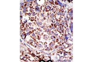 Formalin-fixed and paraffin-embedded human cancer tissue reacted with the primary antibody, which was peroxidase-conjugated to the secondary antibody, followed by DAB staining. (USP3 Antikörper  (C-Term))