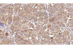 ABIN6276505 at 1/100 staining Human Melanoma tissue by IHC-P. (C19orf10 Antikörper)