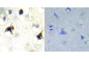Immunohistochemical analysis of paraffin- embedded human brain carcinoma tissue using PDGFR beta (Ab-751) antibody (E022033). (PDGFRB Antikörper)
