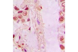 Immunohistochemical analysis of NRF2 staining in human lung cancer formalin fixed paraffin embedded tissue section. (NRF2 Antikörper  (C-Term))