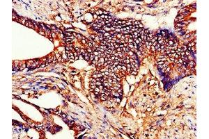 IHC image of ABIN7149184 diluted at 1:200 and staining in paraffin-embedded human colon cancer performed on a Leica BondTM system. (Cytochrome C Antikörper  (AA 2-105))