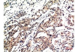 Immunohistochemical analysis of paraffin-embedded Human Breast Carcinoma Tissue using Ubiquitin Mouse mAb diluted at 1:200. (Ubiquitin Antikörper)