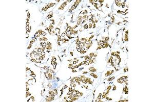 Immunohistochemistry of paraffin-embedded human breast cancer using Lamin A/C Rabbit pAb (ABIN6133798 and ABIN6143078) at dilution of 1:150 (40x lens). (Lamin A/C Antikörper)