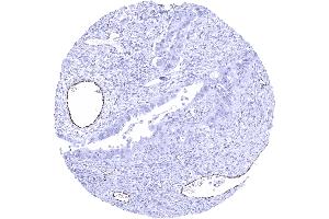 Ovary Serous high grade carcinoma showing distinct endothelial vWF staining in a subset of intratumoral vessels (Rekombinanter VWF Antikörper  (AA 1815-1939))