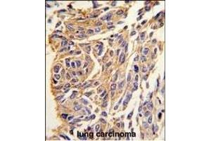 Formalin-fixed and paraffin-embedded human lung carcinoma tissue reacted with T1 antibody (C-term) (ABIN389117 and ABIN2839303) , which was peroxidase-conjugated to the secondary antibody, followed by DAB staining. (PPT1 Antikörper  (C-Term))