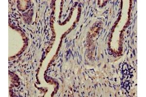 Immunohistochemistry of paraffin-embedded human prostate cancer using ABIN7160004 at dilution of 1:100 (MAPK6 Antikörper  (AA 383-712))