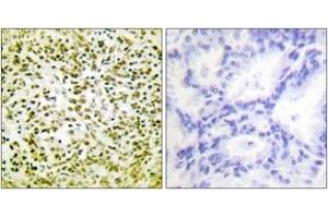 Immunohistochemistry analysis of paraffin-embedded human lung carcinoma tissue, using p53 (Ab-317) Antibody. (p53 Antikörper  (AA 283-332))