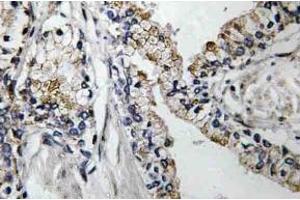 Immunohistochemistry (IHC) analyzes of VDR antibody in paraffin-embedded human prostate carcinoma tissue. (Claudin 7 Antikörper)