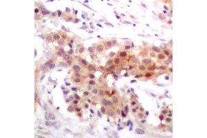 Immunohistochemical analysis of p300 staining in human breast cancer formalin fixed paraffin embedded tissue section. (p300 Antikörper)