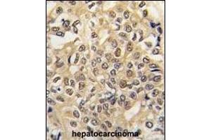 Formalin-fixed and paraffin-embedded human hepatocarcinoma tissue reacted with UBE1 antibody (C-term) (ABIN388844 and ABIN2839150) , which was peroxidase-conjugated to the secondary antibody, followed by DAB staining. (E1 Ubiquitin (AA 1026-1058), (C-Term) Antikörper)