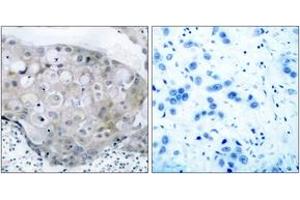 Immunohistochemistry (IHC) image for anti-VEGF Receptor 2 (VEGFR2) (pTyr951) antibody (ABIN2888557) (VEGFR2/CD309 Antikörper  (pTyr951))