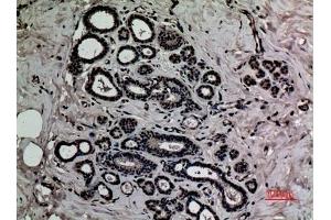 Immunohistochemical analysis of paraffin-embedded human-breast, antibody was diluted at 1:100. (HMGB1 Antikörper  (acLys12))