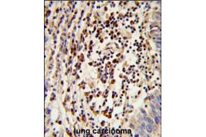 Formalin-fixed and paraffin-embedded human lung carcinoma reacted with MOSC2 Antibody , which was peroxidase-conjugated to the secondary antibody, followed by DAB staining. (MARC2 Antikörper  (C-Term))