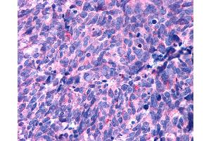 Anti-HTR1B / 5-HT2B Receptor antibody IHC of human Lung, Small Cell Carcinoma. (Serotonin Receptor 2B Antikörper  (N-Term))