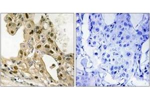 Immunohistochemistry analysis of paraffin-embedded human breast carcinoma, using p53 (Phospho-Thr387) Antibody. (p53 Antikörper  (pThr387))