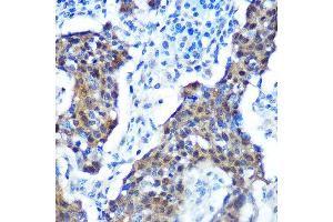 Immunohistochemistry of paraffin-embedded human cervix cancer using [KO Validated] CDKN2A/p16INK4a Rabbit mAb (ABIN6131541, ABIN6139280, ABIN6139282 and ABIN7101380) at dilution of 1:100 (40x lens). (CDKN2A Antikörper)