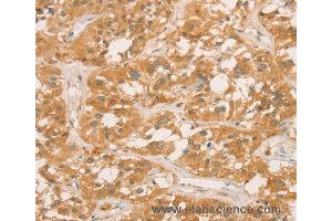 Immunohistochemistry of Human gastric cancer using CPB1 Polyclonal Antibody at dilution of 1:60 (CPB1 Antikörper)