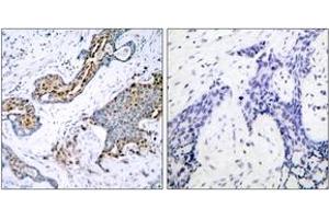Immunohistochemistry analysis of paraffin-embedded human breast carcinoma, using Estrogen Receptor-alpha (Phospho-Ser118) Antibody. (Estrogen Receptor alpha Antikörper  (pSer118))
