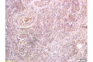 Formalin-fixed and paraffin embedded human endometrial carcinoma labeled with Anti-Inhibin beta B Polyclonal Antibody, Unconjugated (ABIN734993) at 1:200 followed by conjugation to the secondary antibody and DAB staining (Pro-Inhibin beta B (AA 251-350) Antikörper)