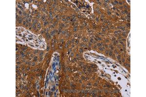 Immunohistochemistry of Human lung cancer using JUP Polyclonal Antibody at dilution of 1:40 (JUP Antikörper)