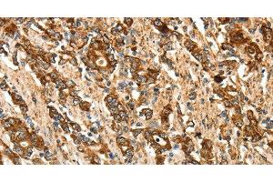 Immunohistochemistry of paraffin-embedded Human gastic cancer using CALR Polyclonal Antibody at dilution of 1:50 (Calreticulin Antikörper)