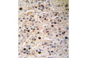 Formalin-fixed and paraffin-embedded human hepatocarcinoma tissue reacted with PCNA antibody , which was peroxidase-conjugated to the secondary antibody, followed by DAB staining. (PCNA Antikörper  (AA 89-117))
