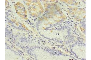 Immunohistochemistry of paraffin-embedded human gastric cancer using ABIN7148027 at dilution of 1:100 (CBLIF (AA 19-417) Antikörper)