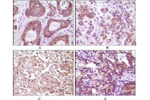 Immunohistochemical analysis of paraffin-embedded human colon carcinoma(A), breast carcinoma(B), kidney cell carcinoma(C), bladder carcinoma tumor(D), showing membrane and cytoplasmic localization using IKBKB mouse mAb with DAB staining. (IKBKB Antikörper)