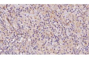 ABIN6273079 at 1/100 staining Human lymph cancer tissue by IHC-P. (SYVN1 Antikörper  (Internal Region))