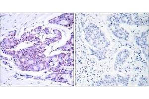 Immunohistochemistry analysis of paraffin-embedded human breast carcinoma tissue, using NF-kappaB p65 (Ab-468) Antibody. (NF-kB p65 Antikörper  (AA 435-484))