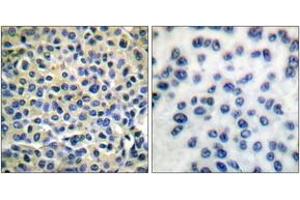 Immunohistochemistry analysis of paraffin-embedded human breast carcinoma tissue, using LIMK1/2 (Ab-508/505) Antibody. (LIMK-1/2 (AA 481-530) Antikörper)