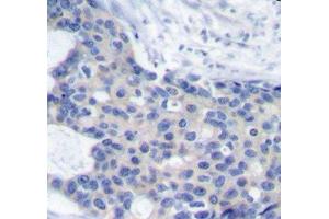 Immunohistochemistry of paraffin-embedded Human breast carcinoma tissue, using Phospho-ZAP70(Y493) Polyclonal Antibody (ZAP70 Antikörper  (pTyr493))