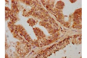 IHC image of ABIN7172814 diluted at 1:600 and staining in paraffin-embedded human prostate cancer performed on a Leica BondTM system. (TGFB1 Antikörper  (AA 281-390))