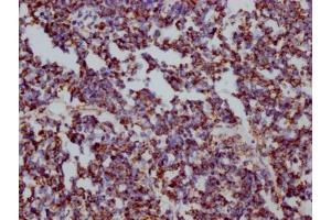 IHC image of ABIN7127551 diluted at 1:100 and staining in paraffin-embedded human liver cancer performed on a Leica BondTM system. (Rekombinanter HSPD1 Antikörper)