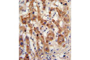 Formalin-fixed and paraffin-embedded human hepatocarcinoma with NAT2 Antibody , which was peroxidase-conjugated to the secondary antibody, followed by DAB staining. (NAT2 Antikörper  (C-Term))