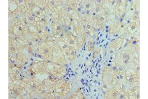 Immunohistochemistry of paraffin-embedded human liver cancer using ABIN7155441 at dilution of 1:100 (HIST1H4A Antikörper  (AA 2-50))