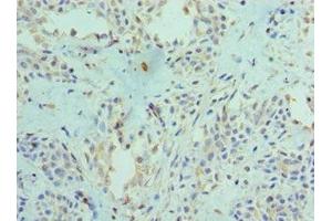 Immunohistochemistry of paraffin-embedded human breast cancer using ABIN7166400 at dilution of 1:100 (PAD4 Antikörper  (AA 1-250))