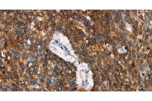 Immunohistochemistry of paraffin-embedded Human lung cancer tissue using CD68 Polyclonal Antibody at dilution 1:30 (CD68 Antikörper)
