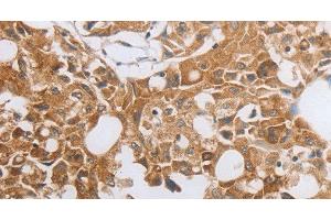 Immunohistochemistry of paraffin-embedded Human lung cancer using MUC20 Polyclonal Antibody at dilution of 1:40 (MUC20 Antikörper)