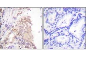 Immunohistochemistry analysis of paraffin-embedded human lung carcinoma tissue, using AML1 (Ab-276) Antibody. (RUNX1 Antikörper  (AA 242-291))
