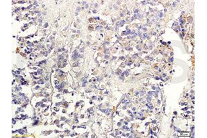 Formalin-fixed and paraffin embedded human colon carcinoma labeled with Anti-TGF-beta-2 Polyclonal Antibody, Unconjugated (ABIN724880) 1:300 followed by conjugation to the secondary antibody and DAB staining (TGF beta 2 Propeptide (AA 154-197) Antikörper)